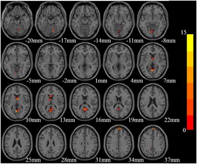 Regional activity alterations in Parkinson’s disease patients with anxiety disorders: A resting-state functional magnetic resonance imaging study